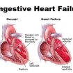 heart failure