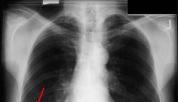 non-small cell lung cancer