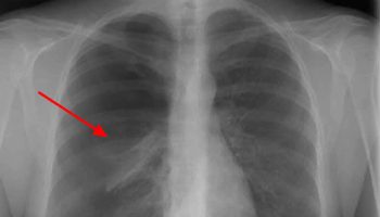 spontaneous-pneumothorax