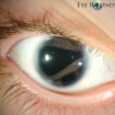 Axenfeld-Rieger syndrome eye
