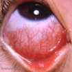 Bacterial conjunctivitis