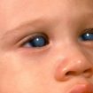 Congenital glaucoma