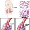infant-respiratory-distress-syndrome