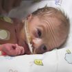 intrauterine growth restriction