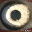 pigmentary glaucoma