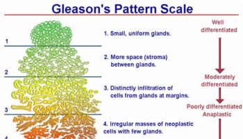 Gleason score