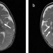 Leigh syndrome