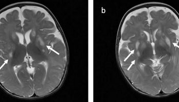 Leigh syndrome