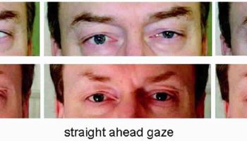Miller-Fisher-syndrome