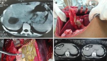Hydatid cyst