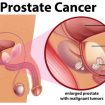 prostate-cancer