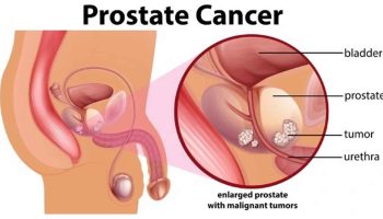 prostate-cancer