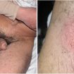 Lymphogranuloma-venereum