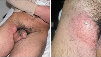 Lymphogranuloma-venereum