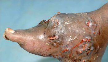 Mycetoma