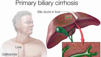 Primary biliary cirrhosis