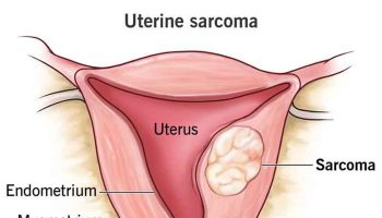 Uterine Sarcoma