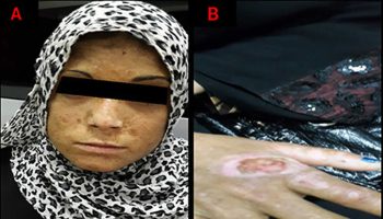 Congenital erythropoietic porphyria