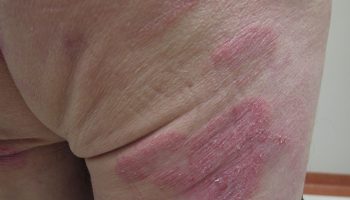 Mycosis-fungoides-rash