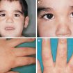 hepatoerythropoietic porphyria