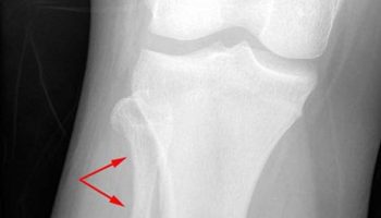 Ewing sarcoma