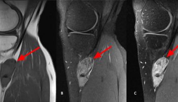 Synovial sarcoma knee MRI scan