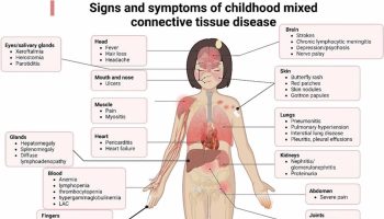 connective tissue diseases