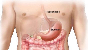 gastrointestinal-stromal-tumor