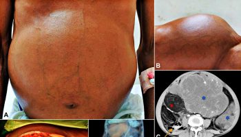 liposarcoma