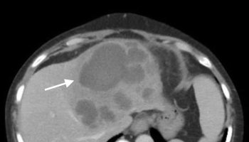 Liver abscess
