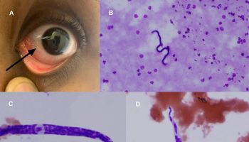 Loiasis