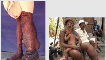 Lymphatic filariasis