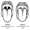 Mallampati-classification