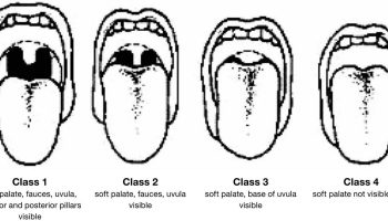 Mallampati-classification