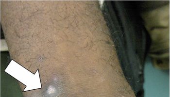 Mansonellosis
