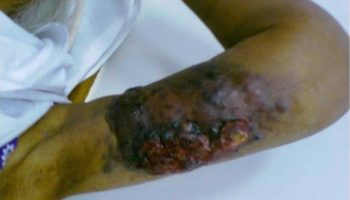 lymphangiosarcoma