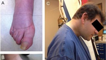multiple system atrophy