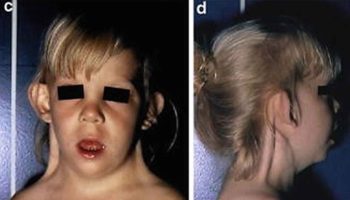 Gonadal dysgenesis
