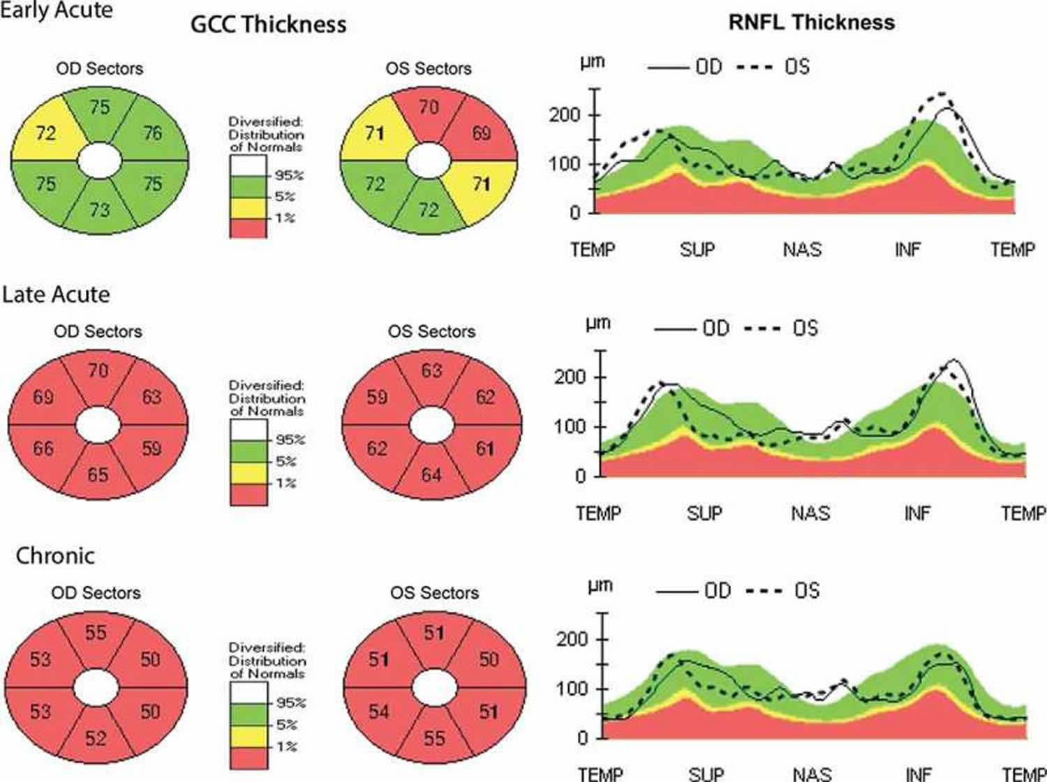Leber Hereditary Optic Neuropathy OCT
