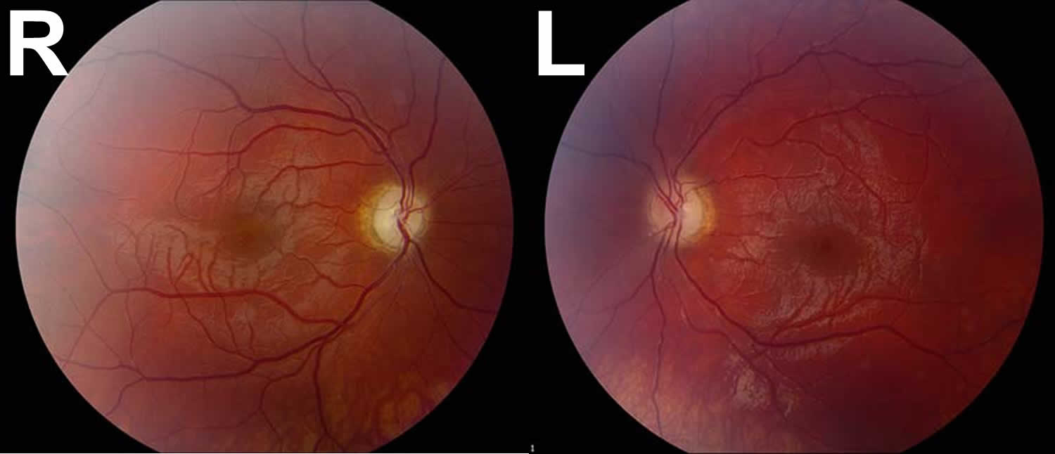 Leber Hereditary Optic Neuropathy