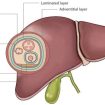 Liver hydatid disease