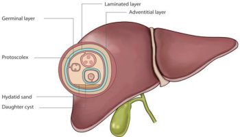 Liver hydatid disease