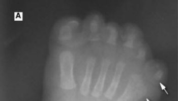 McKusick-Kaufman syndrome postaxial polydactyly