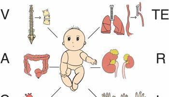 VACTERL association syndrome