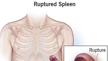 ruptured spleen