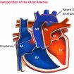 transposition of the great arteries
