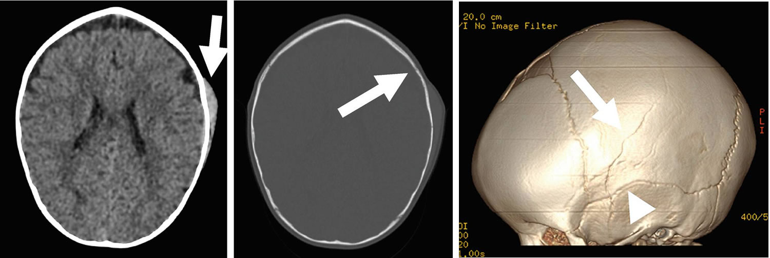 cephalohematoma in adults