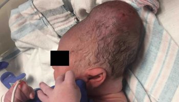 Cephalohematoma in infant