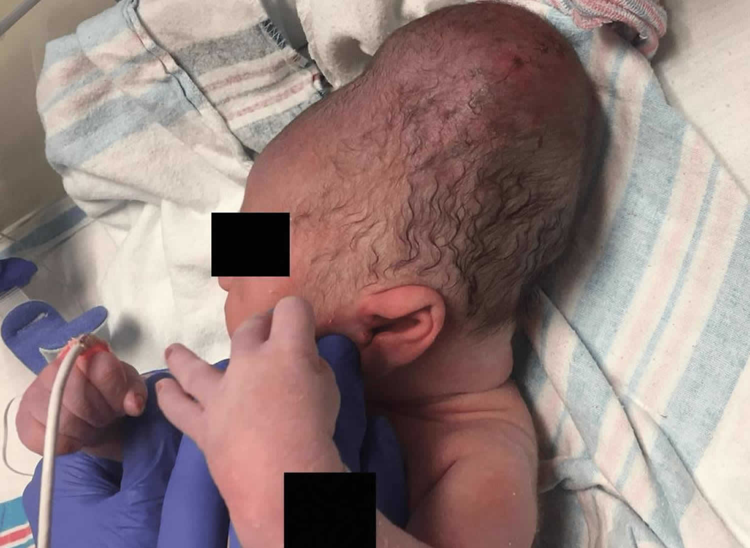 Cephalohematoma in infant