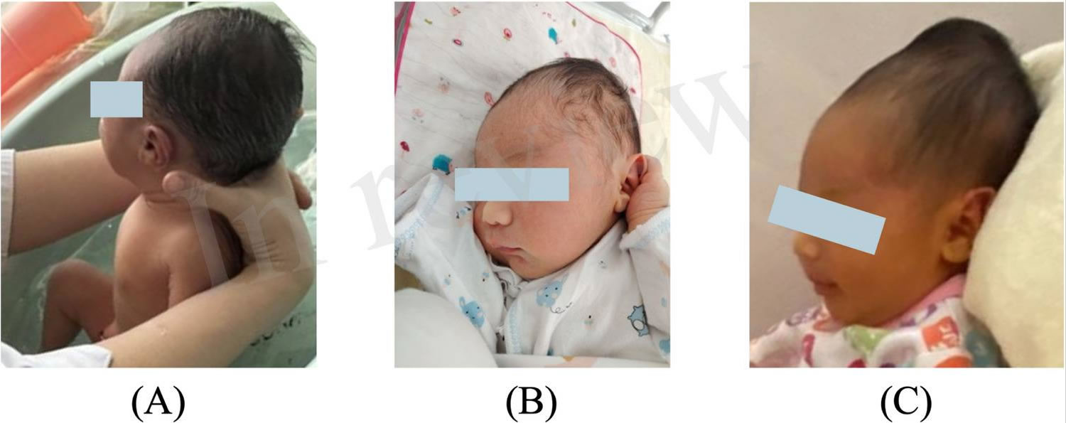 Cephalohematoma progressive enlargement